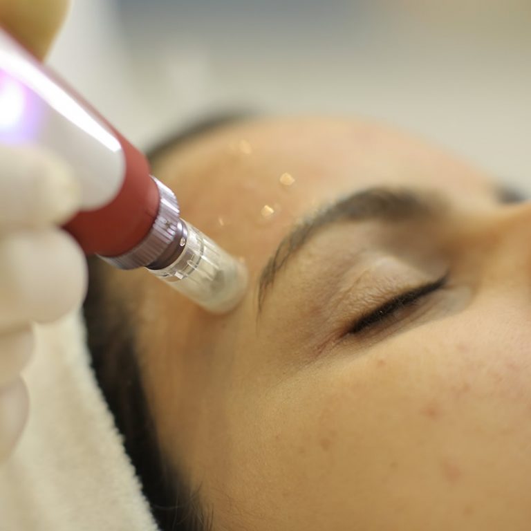 Dermapen en axilas_2