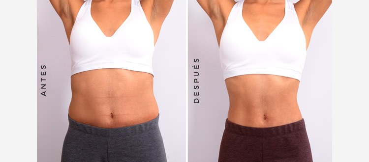 cmslim_antes_despues