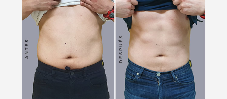 cmslim_antes_despues2